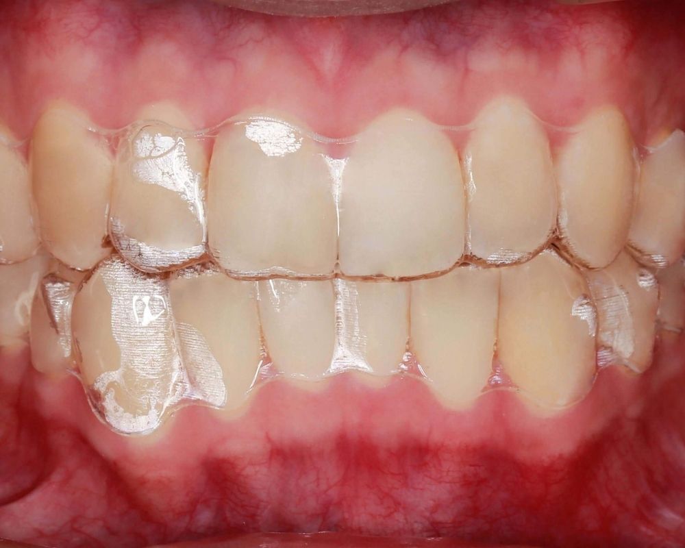 NIỀNG RĂNG TRONG SUỐT INVISALIGN